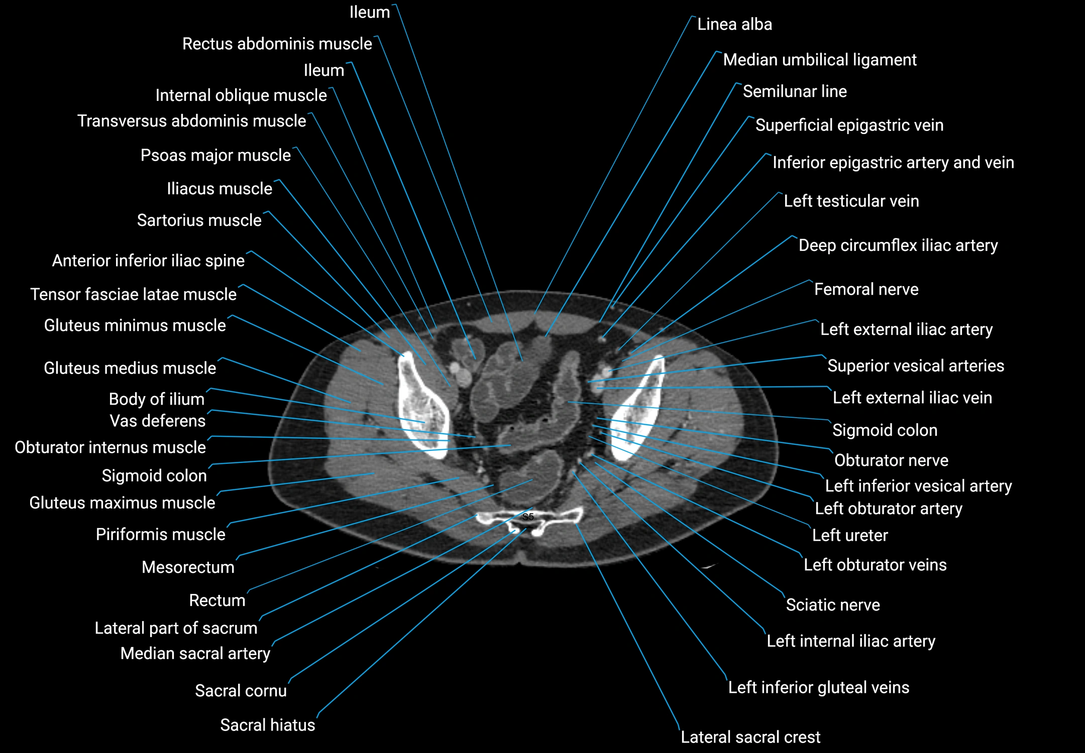CT male pelvis axial cross sectional anatomy labelled radiology image -00171.webp
